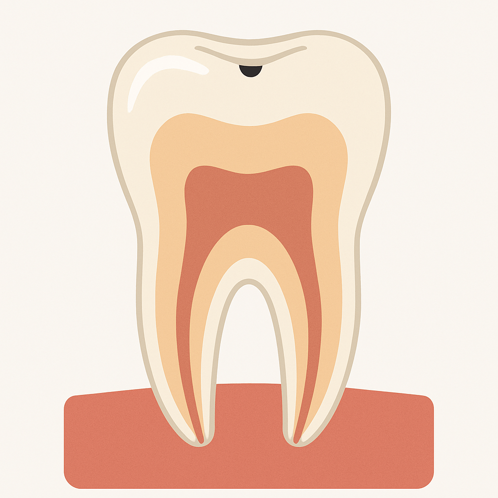 Ilustração de um dente com uma pequena lesão de cárie na superfície do esmalte.
