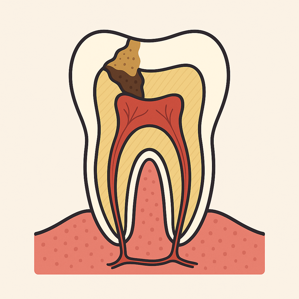 Dente com cárie progredindo para a camada de dentina.