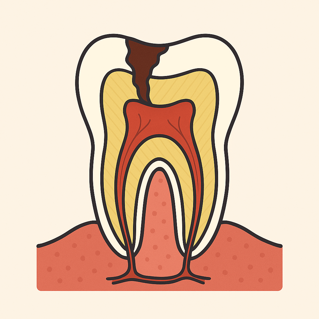 Dente com uma cavidade de cárie grande e profunda, atingindo a polpa.