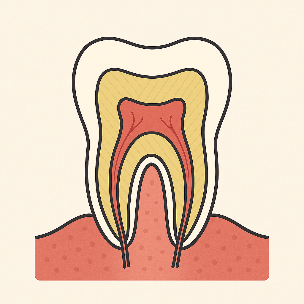 Ilustração de um dente saudável após a remoção da cárie e restauração.