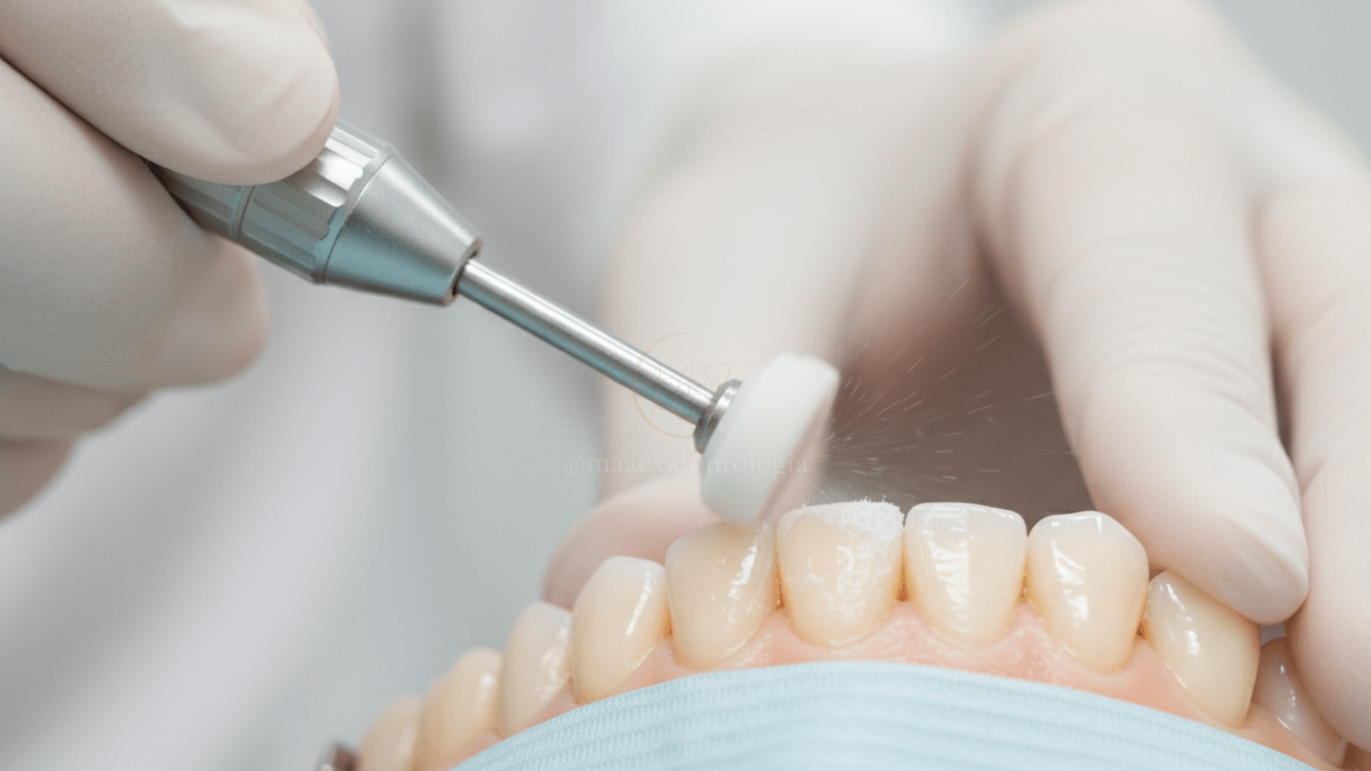 Dentista utilizando instrumento de polimento para remover resina do dente