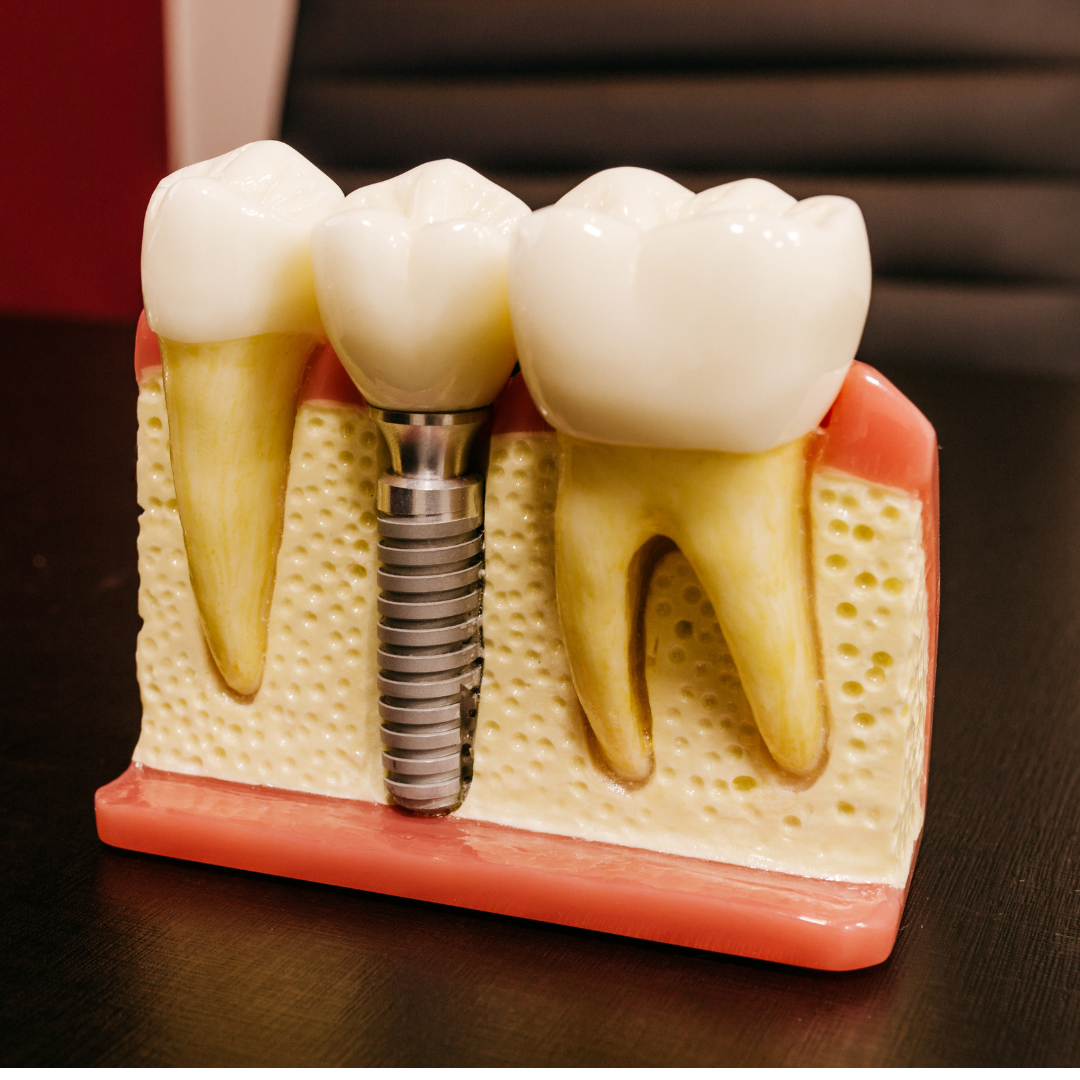 Ilustração mostrando o pino de titânio de um implante dentário e a coroa protética.