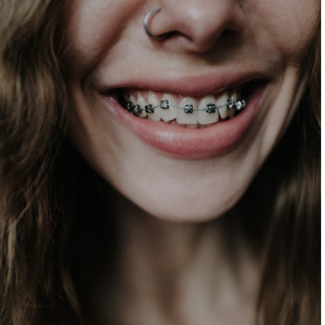 Paciente sorrindo com um aparelho ortodôntico estético de safira.