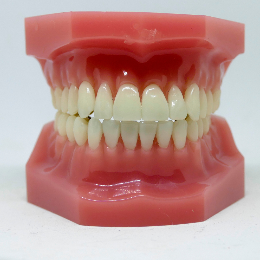 Modelo de uma prótese parcial removível (PPR).