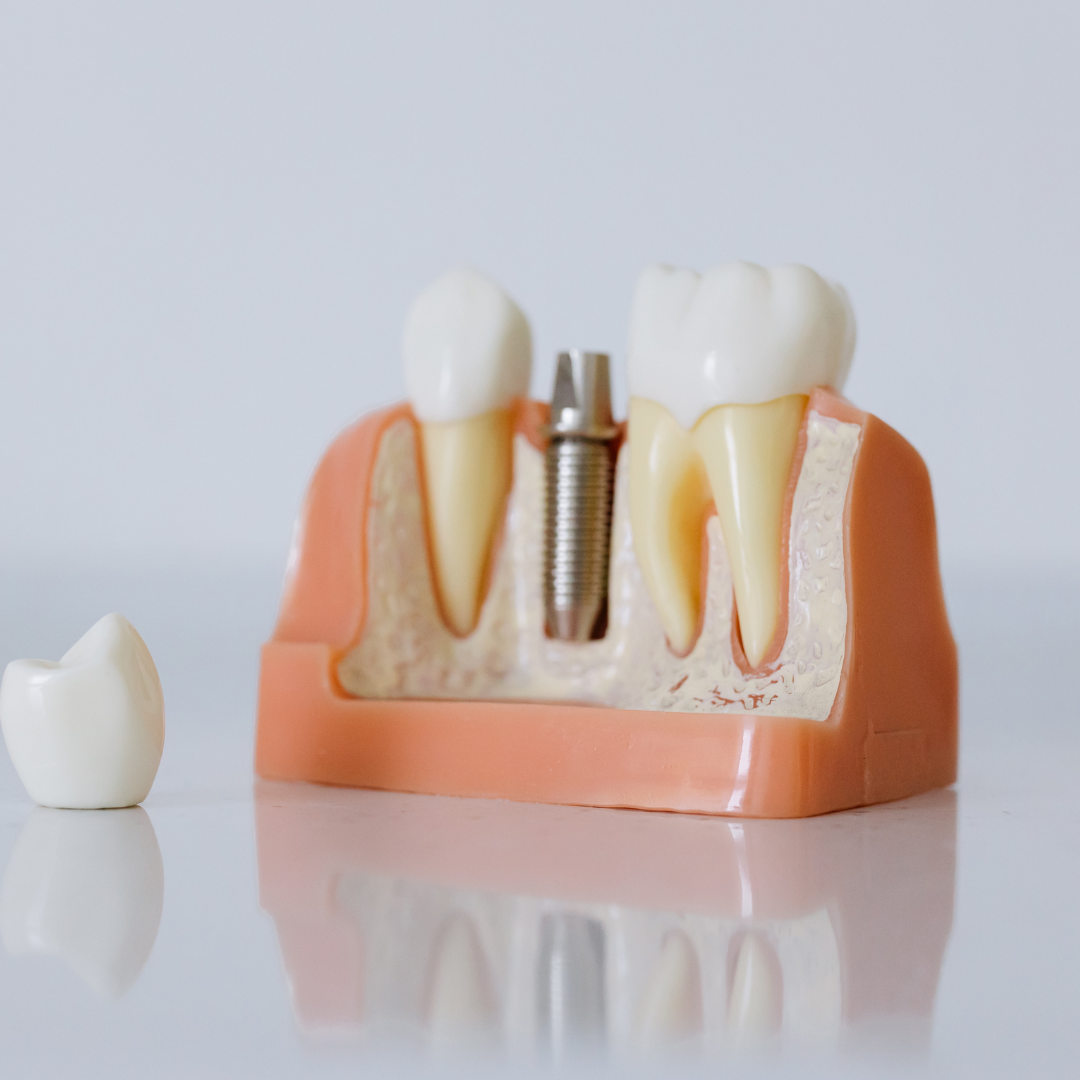Exemplo de uma coroa de porcelana (prótese fixa) sobre um implante dentário.